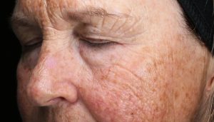 neogen-plasma-treatment-guide