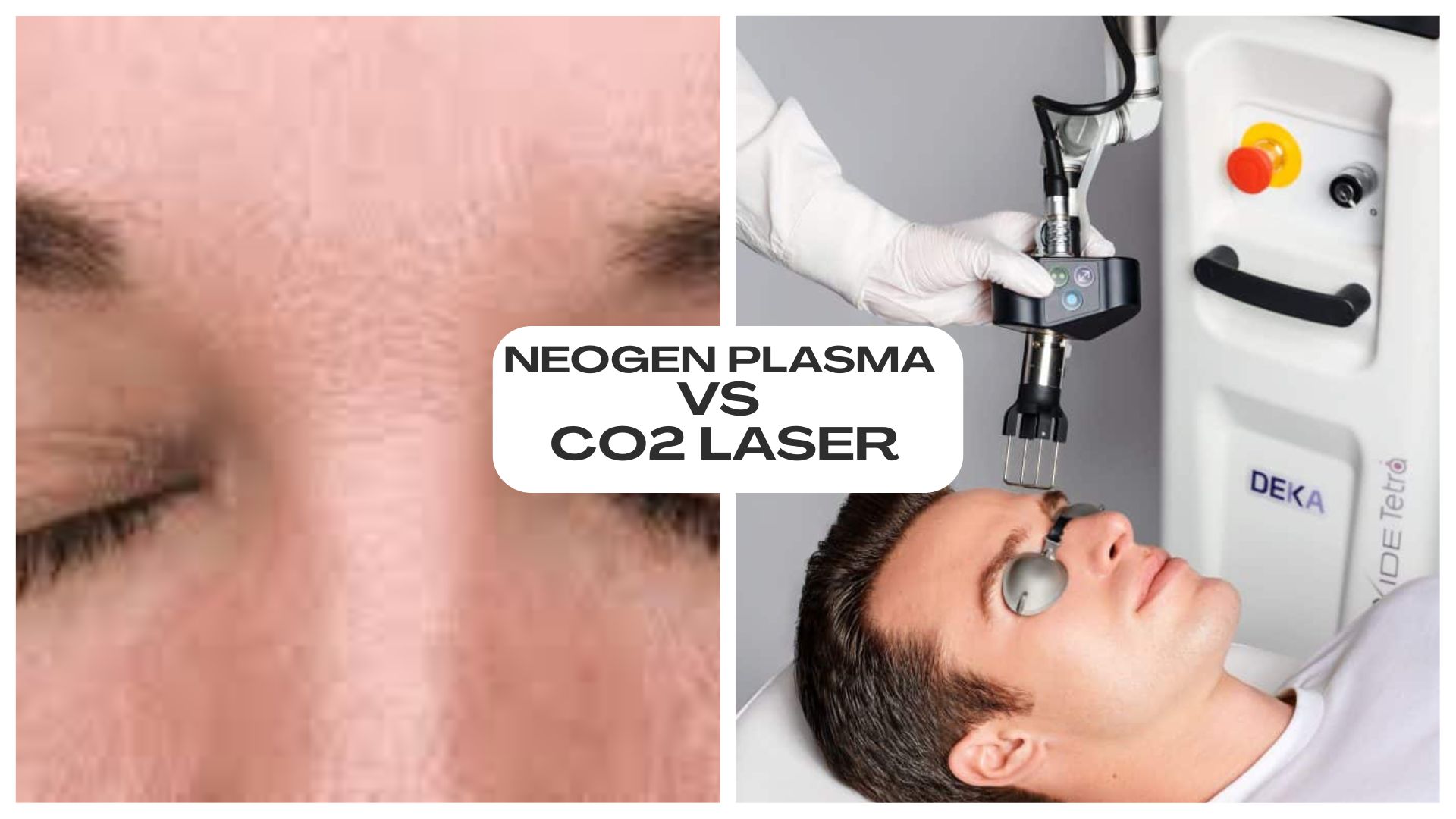 NeoGen Plasma vs CO2 Laser