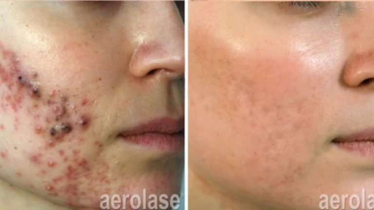 neogen-plasma-acne-scars
