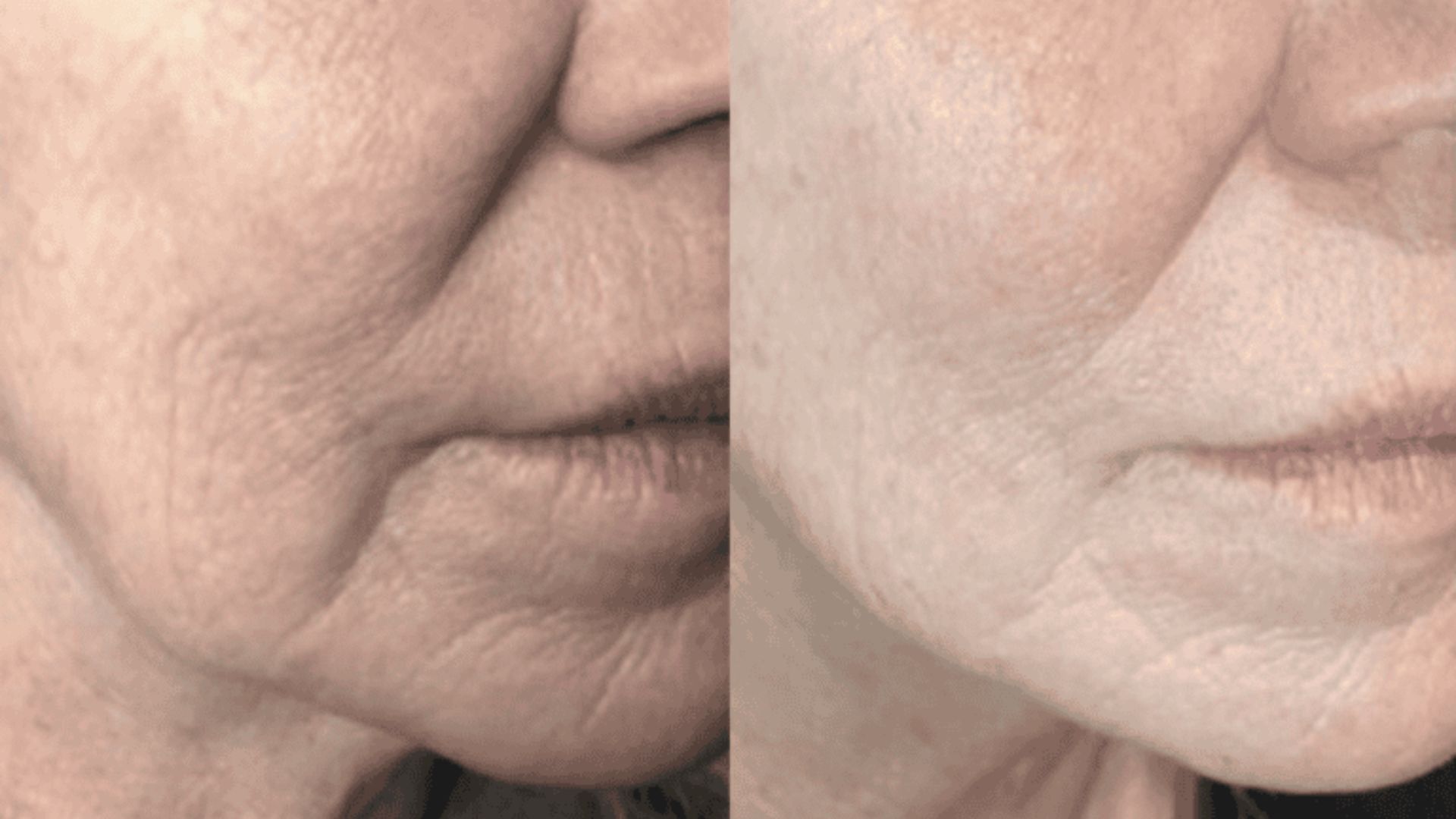 neogen-plasma-for-anti-aging
