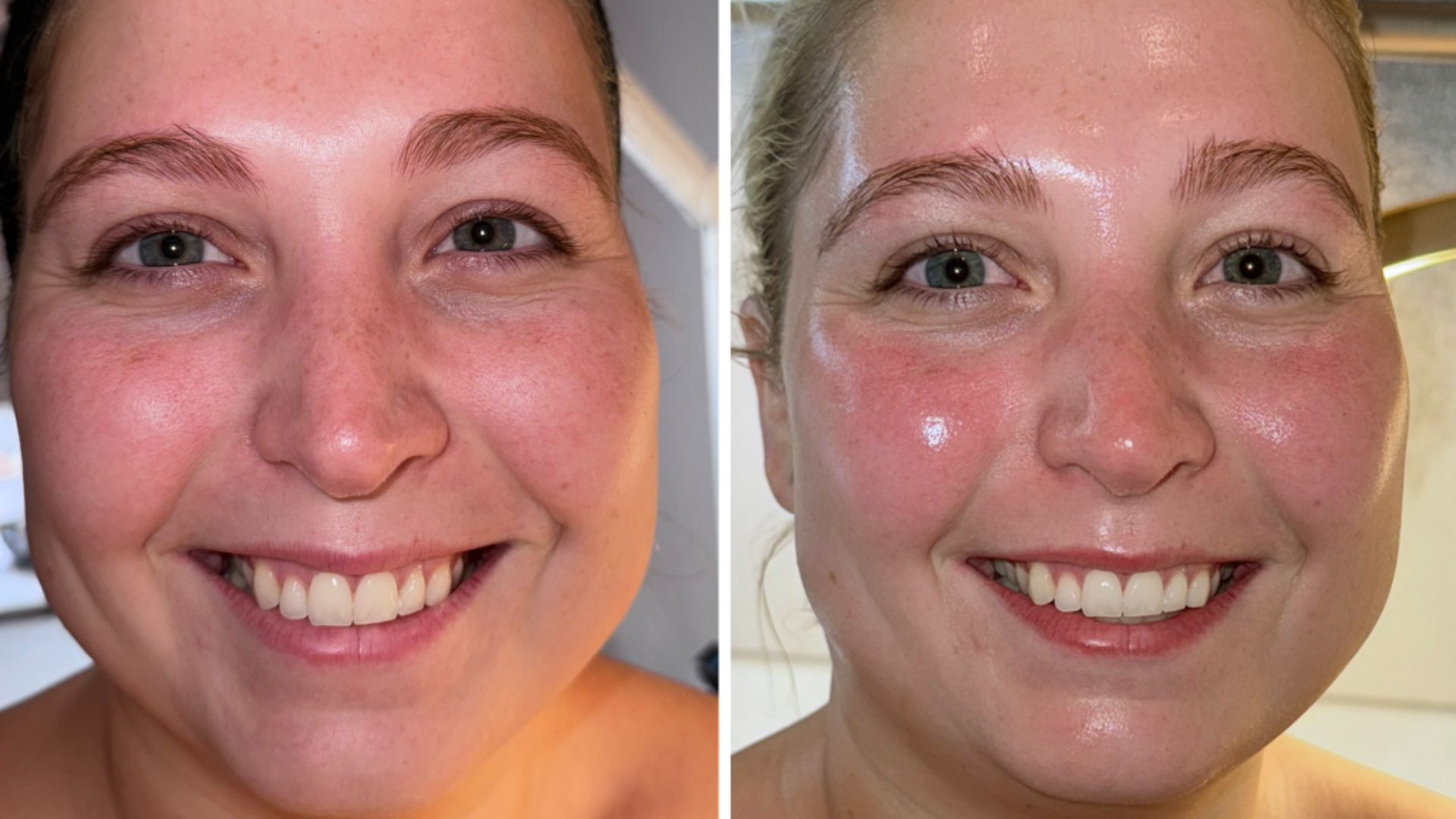 neogen-plasma-for-anti-aging