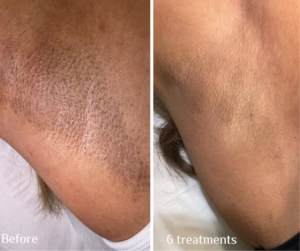 Before and after laser hair removal treatment results on skin at Blue Divine Aesthetics.
