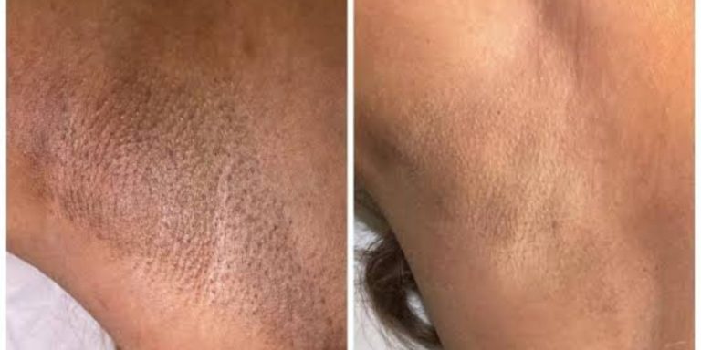 LASER HAIR REMOVAL COST bluedivine
